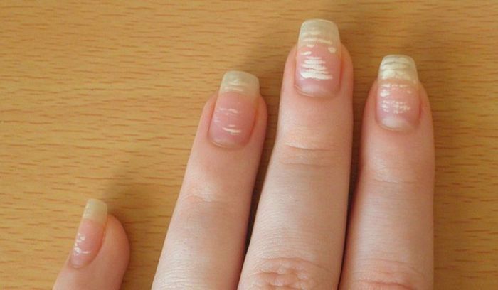 лечение белых ногтевых пятен