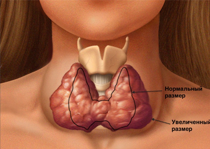 увеличение щитовидной железы