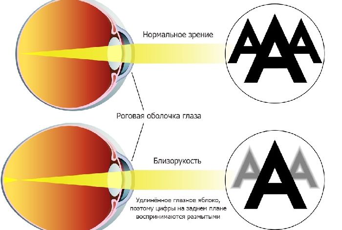 близорукость и нормальное зрение